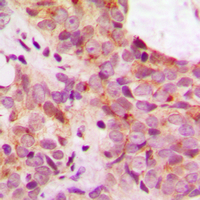 MAPT / Tau Antibody - Immunohistochemical analysis of TAU (pS356) staining in human breast cancer formalin fixed paraffin embedded tissue section. The section was pre-treated using heat mediated antigen retrieval with sodium citrate buffer (pH 6.0). The section was then incubated with the antibody at room temperature and detected using an HRP conjugated compact polymer system. DAB was used as the chromogen. The section was then counterstained with hematoxylin and mounted with DPX.
