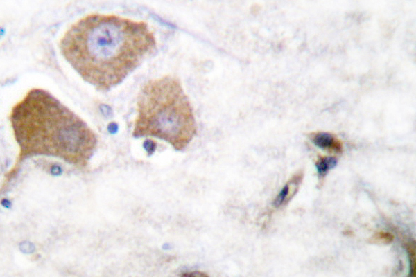MAPT / Tau Antibody - IHC of p-Tau (S396) pAb in paraffin-embedded human breast carcinoma tissue.