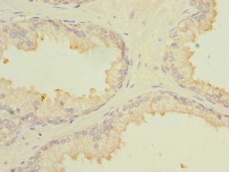 MARCKSL1 Antibody - Immunohistochemistry of paraffin-embedded human prostate cancer at dilution 1:100