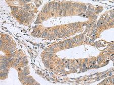 MARCKSL1 Antibody - Immunohistochemistry of paraffin-embedded Human colorectal cancer tissue  using MARCKSL1 Polyclonal Antibody at dilution of 1:50(×200)