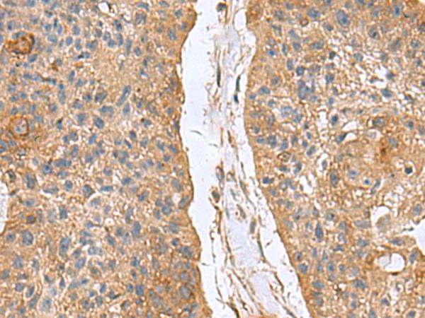 MARCKSL1 Antibody - Immunohistochemistry of paraffin-embedded Human esophagus cancer tissue  using MARCKSL1 Polyclonal Antibody at dilution of 1:70(×200)