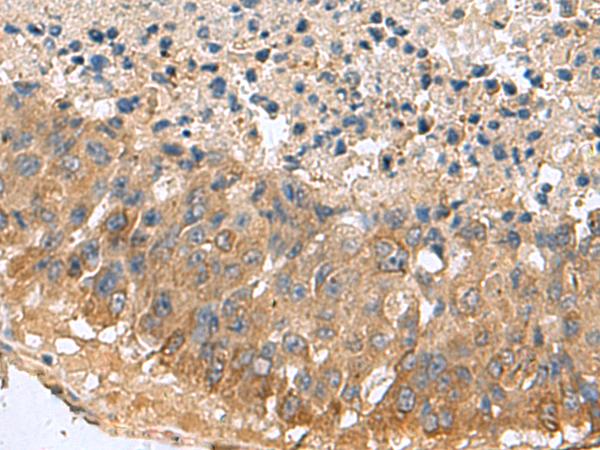 MARCKSL1 Antibody - Immunohistochemistry of paraffin-embedded Human liver cancer tissue  using MARCKSL1 Polyclonal Antibody at dilution of 1:70(×200)