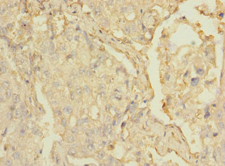 MARCO Antibody - Immunohistochemistry of paraffin-embedded human lung cancer at dilution 1:100