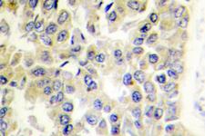 MARK1+2+3+4 Antibody - IHC of MARK1/2/3/4 (N211) pAb in paraffin-embedded human breast carcinoma tissue.