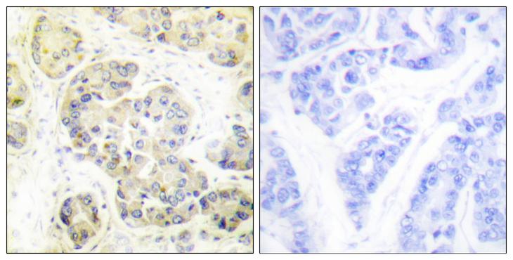 MARK1+2+3+4 Antibody - Peptide - + Immunohistochemistry analysis of paraffin-embedded human breast carcinoma tissue using MARK1/2/3/4 (Ab-215) antibody.