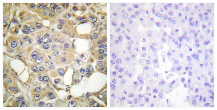 MARK1+2+3+4 Antibody - P-peptide - + Immunohistochemistry analysis of paraffin-embedded human breast carcinoma tissue, using MARK1/2/3/4 (Phospho-Thr215) antibody.