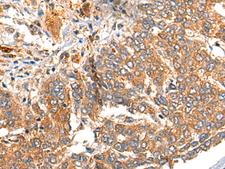 MARK2 Antibody - Immunohistochemistry of paraffin-embedded Human liver cancer tissue  using MARK2 Polyclonal Antibody at dilution of 1:35(×200)