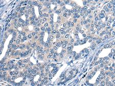 MARK2 Antibody - Immunohistochemistry of paraffin-embedded Human liver cancer tissue  using MARK2 Polyclonal Antibody at dilution of 1:25(×200)