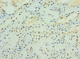 MAS1 / MAS Antibody - Immunohistochemistry of paraffin-embedded human breast cancer using antibody at 1:100 dilution.