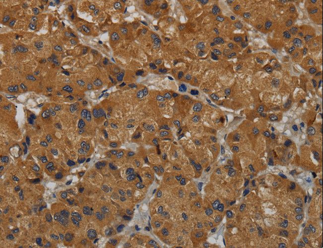 MAS1 / MAS Antibody - Immunohistochemistry of paraffin-embedded Human liver cancer using MAS1 Polyclonal Antibody at dilution of 1:50.