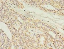 MAS1L / MRG Antibody - Immunohistochemistry of paraffin-embedded human breast cancer using antibody at 1:100 dilution.