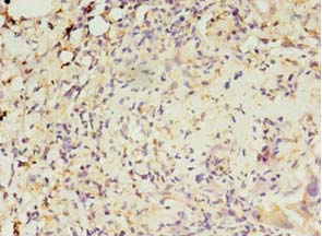 MAS1L / MRG Antibody - Immunohistochemistry of paraffin-embedded human lung cancer using antibody at 1:100 dilution.