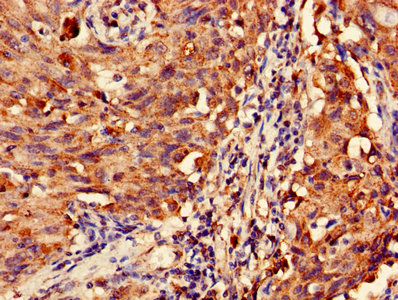 MAS1L / MRG Antibody - Immunohistochemistry of paraffin-embedded human breast cancer using MAS1L Antibody at dilution of 1:100