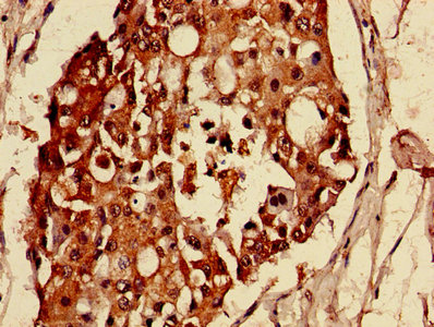 MAS1L / MRG Antibody - Immunohistochemistry of paraffin-embedded human lung cancer using MAS1L Antibody at dilution of 1:100