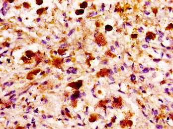 MASP2 / MASP-2 Antibody - Immunohistochemistry image at a dilution of 1:100 and staining in paraffin-embedded human melanoma cancer performed on a Leica BondTM system. After dewaxing and hydration, antigen retrieval was mediated by high pressure in a citrate buffer (pH 6.0) . Section was blocked with 10% normal goat serum 30min at RT. Then primary antibody (1% BSA) was incubated at 4 °C overnight. The primary is detected by a biotinylated secondary antibody and visualized using an HRP conjugated SP system.