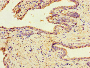 MAST1 Antibody - Immunohistochemistry of paraffin-embedded human prostate cancer at dilution of 1:100