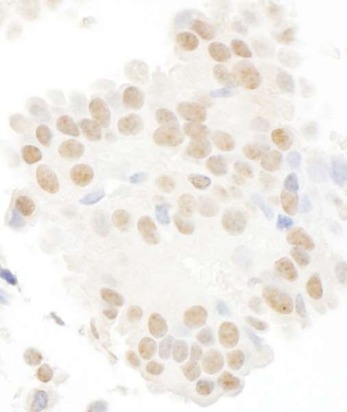 MASTL / GW Antibody - Detection of Human MASTL by Immunohistochemistry. Sample: FFPE section of human ovarian carcinoma. Antibody: Affinity purified rabbit anti-MASTL used at a dilution of 1:250.