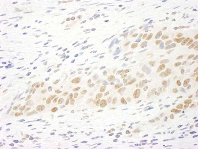 MASTL / GW Antibody - Detection of Human MASTL by Immunohistochemistry. Sample: FFPE section of human lung carcinoma. Antibody: Affinity purified rabbit anti-MASTL used at a dilution of 1:250.