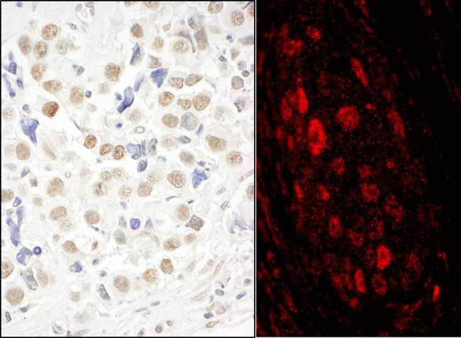 MASTL / GW Antibody - Detection of Human MASTL by Immunohistochemistry and Immunofluorescence. Sample: FFPE sections of human testicular seminoma (left) and lung carcinoma (right). Antibody: Affinity purified rabbit anti-MASTL used at a dilution of 1:1000 (1 ug/ml) and 1:500 (2 ug/ml). Detection: DAB and Red-fluorescent Goat anti-Rabbit IgG-heavy and light chain, cross-adsorbed Antibody DyLight 594 Conjugated used at a dilution of 1:100.