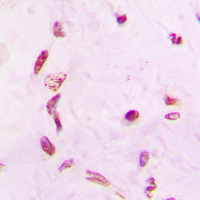 MASTL / GW Antibody - Immunohistochemical analysis of GW staining in human lung cancer formalin fixed paraffin embedded tissue section. The section was pre-treated using heat mediated antigen retrieval with sodium citrate buffer (pH 6.0). The section was then incubated with the antibody at room temperature and detected using an HRP conjugated compact polymer system. DAB was used as the chromogen. The section was then counterstained with hematoxylin and mounted with DPX.