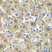 MAT / MAT1A Antibody - Immunohistochemistry of paraffin-embedded human liver injury tissue.