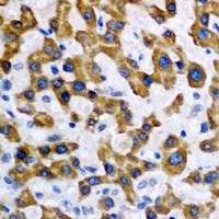 MAT / MAT1A Antibody - Immunohistochemical analysis of MAT1A staining in human liver cancer formalin fixed paraffin embedded tissue section. The section was pre-treated using heat mediated antigen retrieval with sodium citrate buffer (pH 6.0). The section was then incubated with the antibody at room temperature and detected using an HRP conjugated compact polymer system. DAB was used as the chromogen. The section was then counterstained with hematoxylin and mounted with DPX.