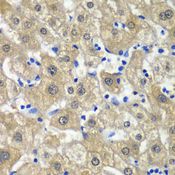 MAT / MAT1A Antibody - Immunohistochemistry of paraffin-embedded human liver injury using MAT1A antibody at dilution of 1:100 (40x lens).