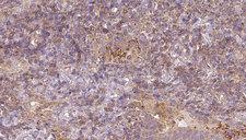 MAT / MAT1A Antibody - 1:100 staining human lymph carcinoma tissue by IHC-P. The sample was formaldehyde fixed and a heat mediated antigen retrieval step in citrate buffer was performed. The sample was then blocked and incubated with the antibody for 1.5 hours at 22°C. An HRP conjugated goat anti-rabbit antibody was used as the secondary.
