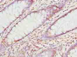 MAT2A Antibody - Immunohistochemistry of paraffin-embedded human colon cancer using antibody at dilution of 1:100.