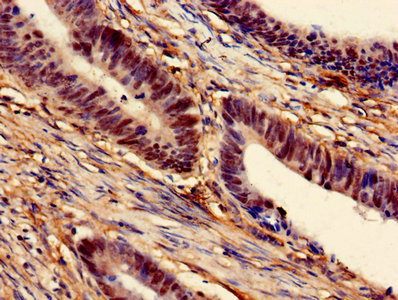 MAT2A Antibody - Immunohistochemistry of paraffin-embedded human colon cancer using MAT2A Antibody at dilution of 1:100