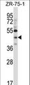 MATH2 / NEUROD6 Antibody - NEUROD6 Antibody (N-term ) western blot of ZR-75-1 cell line lysates (35 ug/lane). The NEUROD6 antibody detected the NEUROD6 protein (arrow).