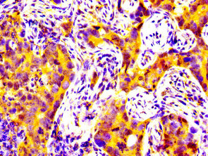 MATN2 / Matrilin 2 Antibody - Immunohistochemistry image at a dilution of 1:200 and staining in paraffin-embedded human pancreatic cancer performed on a Leica BondTM system. After dewaxing and hydration, antigen retrieval was mediated by high pressure in a citrate buffer (pH 6.0) . Section was blocked with 10% normal goat serum 30min at RT. Then primary antibody (1% BSA) was incubated at 4 °C overnight. The primary is detected by a biotinylated secondary antibody and visualized using an HRP conjugated SP system.