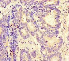 MAX Antibody - Immunohistochemistry of paraffin-embedded human colon cancer at dilution of 1:100