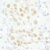 MAZ Antibody - Detection of Human MAZ/SAF-1 by Immunohistochemistry. Sample: FFPE section of human breast carcinoma. Antibody: Affinity purified rabbit anti-MAZ/SAF-1 used at a dilution of 1:250.