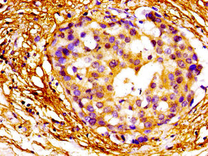 MAZ Antibody - Immunohistochemistry image of paraffin-embedded human breast cancer at a dilution of 1:100