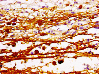 MAZ Antibody - Immunohistochemistry image of paraffin-embedded human melanoma cancer at a dilution of 1:100
