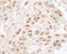 MBD3 Antibody - Detection of Human MBD3 by Immunohistochemistry. Sample: FFPE section of human breast carcinoma. Antibody: Affinity purified rabbit anti-MBD3 used at a dilution of 1:1000 (1 Detection: DAB.