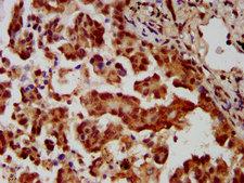 MBIP Antibody - Immunohistochemistry image at a dilution of 1:400 and staining in paraffin-embedded human lung cancer performed on a Leica BondTM system. After dewaxing and hydration, antigen retrieval was mediated by high pressure in a citrate buffer (pH 6.0) . Section was blocked with 10% normal goat serum 30min at RT. Then primary antibody (1% BSA) was incubated at 4 °C overnight. The primary is detected by a biotinylated secondary antibody and visualized using an HRP conjugated SP system.
