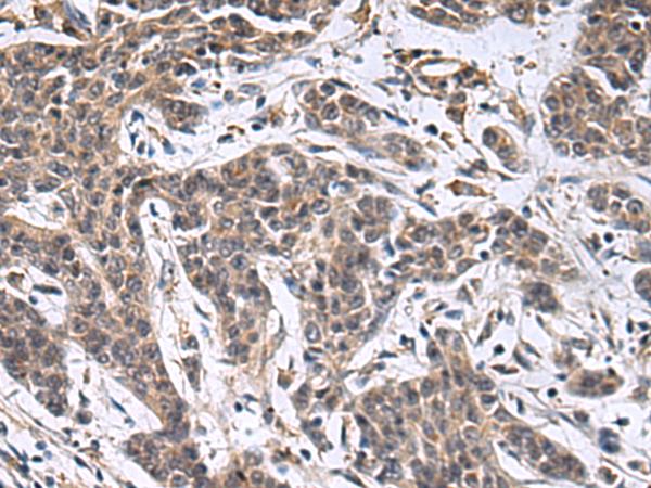 MBL2 / Mannose Binding Protein Antibody - Immunohistochemistry of paraffin-embedded Human colorectal cancer tissue  using MBL2 Polyclonal Antibody at dilution of 1:25(×200)