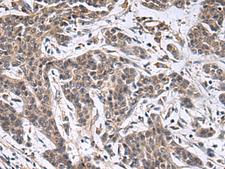 MBL2 / Mannose Binding Protein Antibody - Immunohistochemistry of paraffin-embedded Human colorectal cancer tissue  using MBL2 Polyclonal Antibody at dilution of 1:25(×200)