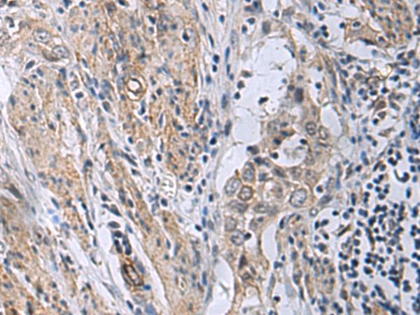 MBL2 / Mannose Binding Protein Antibody - Immunohistochemistry of paraffin-embedded Human esophagus cancer tissue  using MBL2 Polyclonal Antibody at dilution of 1:25(×200)
