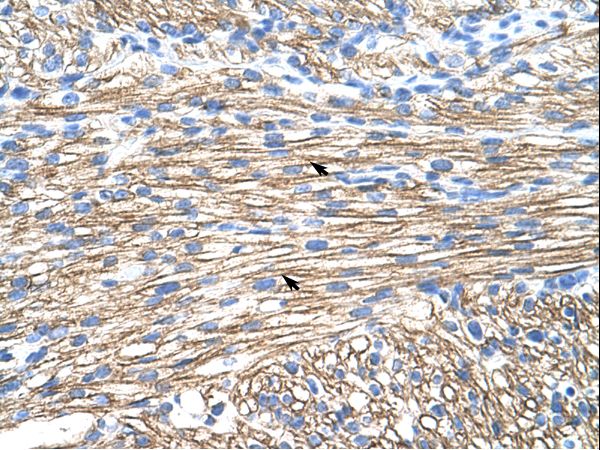 MBNL1 / MBNL Antibody - MBNL1 antibody ARP41227_P050-AAH50535-MBNL1 (muscleblind-like (Drosophila)) Antibody was used in IHC to stain formalin-fixed, paraffin-embedded human heart.  This image was taken for the unconjugated form of this product. Other forms have not been tested.