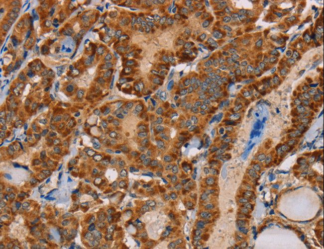 MBNL3 Antibody - Immunohistochemistry of paraffin-embedded Human cervical cancer using MBNL3 Polyclonal Antibody at dilution of 1:30.