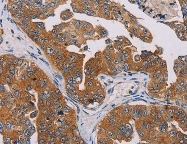 MBNL3 Antibody - Immunohistochemistry of paraffin-embedded Human cervical cancer using MBNL3 Polyclonal Antibody at dilution of 1:30.