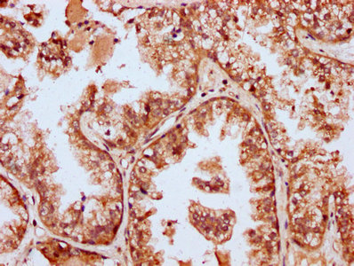 MBNL3 Antibody - Immunohistochemistry Dilution at 1:400 and staining in paraffin-embedded human prostate cancer performed on a Leica BondTM system. After dewaxing and hydration, antigen retrieval was mediated by high pressure in a citrate buffer (pH 6.0). Section was blocked with 10% normal Goat serum 30min at RT. Then primary antibody (1% BSA) was incubated at 4°C overnight. The primary is detected by a biotinylated Secondary antibody and visualized using an HRP conjugated SP system.