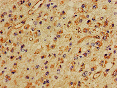MBP / Myelin Basic Protein Antibody - Immunohistochemistry Dilution at 1:400 and staining in paraffin-embedded human glioma cancer performed on a Leica BondTM system. After dewaxing and hydration, antigen retrieval was mediated by high pressure in a citrate buffer (pH 6.0). Section was blocked with 10% normal Goat serum 30min at RT. Then primary antibody (1% BSA) was incubated at 4°C overnight. The primary is detected by a biotinylated Secondary antibody and visualized using an HRP conjugated SP system.