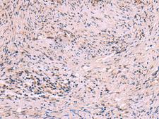 MBTPS2 Antibody - Immunohistochemistry of paraffin-embedded Human cervical cancer tissue  using MBTPS2 Polyclonal Antibody at dilution of 1:30(×200)