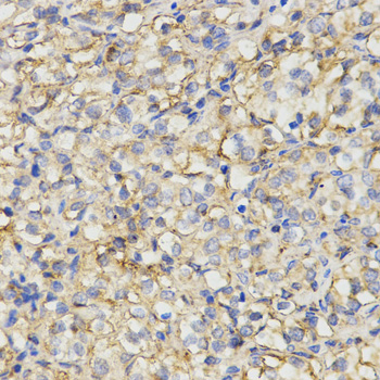 MC1R Antibody - Immunohistochemistry of paraffin-embedded human kidney cancer tissue using MC1R antibody at dilution of 1:200 (x400 lens)