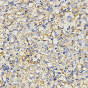 MC1R Antibody - Immunohistochemistry of paraffin-embedded human kidney cancer tissue using MC1R antibody at dilution of 1:200 (x400 lens)