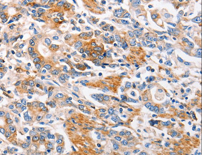 MC1R Antibody - Immunohistochemistry of paraffin-embedded Human gastric cancer using MC1R Polyclonal Antibody at dilution of 1:100.